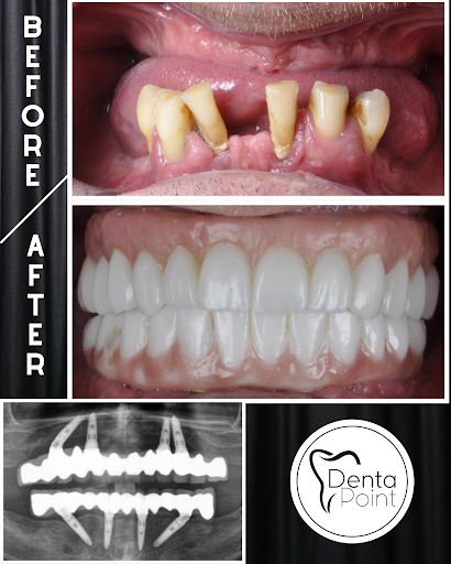 DentaPoint International - Alsancak Şubesi Zirkonyum , Diş İmplantı , Estetik Diş Tedavileri , Çocuk Diş — 4