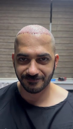 زراعة الشعر في تركيا |jawad Medical turkey — 3