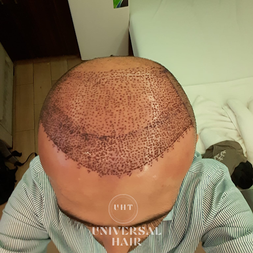 Universal Hair Transplant - Best Hair Transplant in Turkey — 4