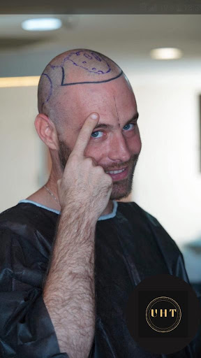 Universal Hair Transplant - Best Hair Transplant in Turkey