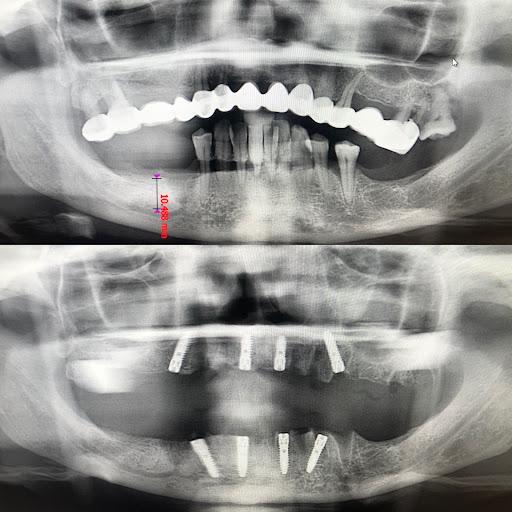 Best Dentist in Turkey İstanbul - Dr. Samet - Dental Implants Turkey - Best Dental Clinic in Turkey — 3