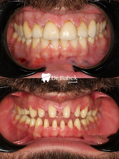 Babek Dent